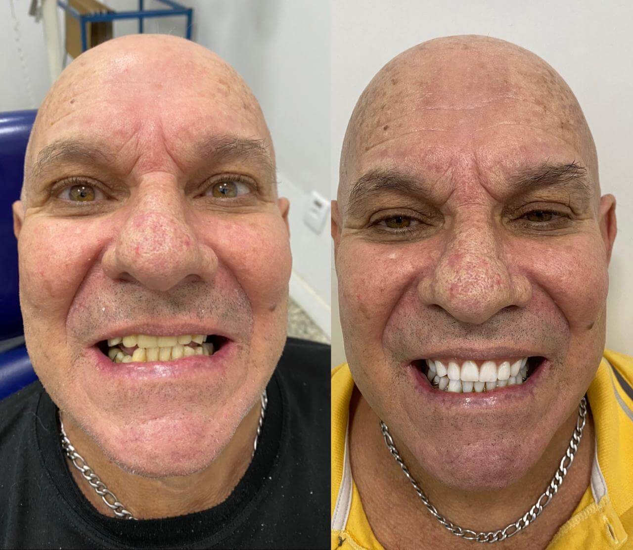Antes-e-depois-_1_